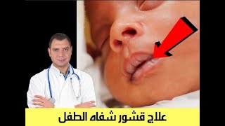 علاج قشور شفاه الطفل