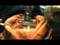 Total Knee Replacement Surgery Part 2 - Update 2011