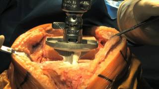 Total Knee Replacement Surgery Part 2 - Update 2011