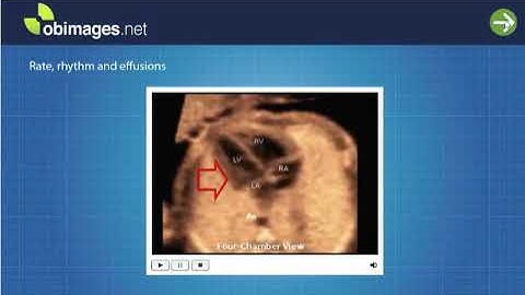 5. Step 5. The detailed 4-chamber cardiac view.