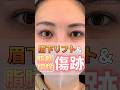 ぷっくりした瞼には、眉下リフトと脂肪切除👀✨ #眉下切開 #眉下リフト #美容整形 #ダウンタイム