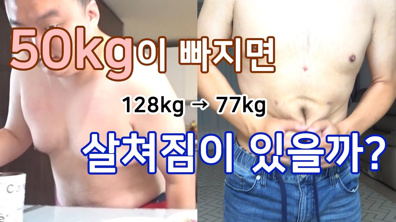 50kg 다이어트 성공 후 살쳐짐 그리고 피부 수술 비용