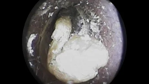 耳掃除 23年間耳かきしなかった男が2度目の耳掃除をしてみたらヤバすぎた Mp3