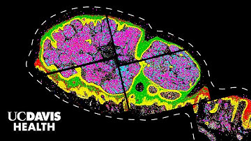 New Genetic Clues About Melanoma Revealed Through Powerful Imaging | UC Davis Health Research