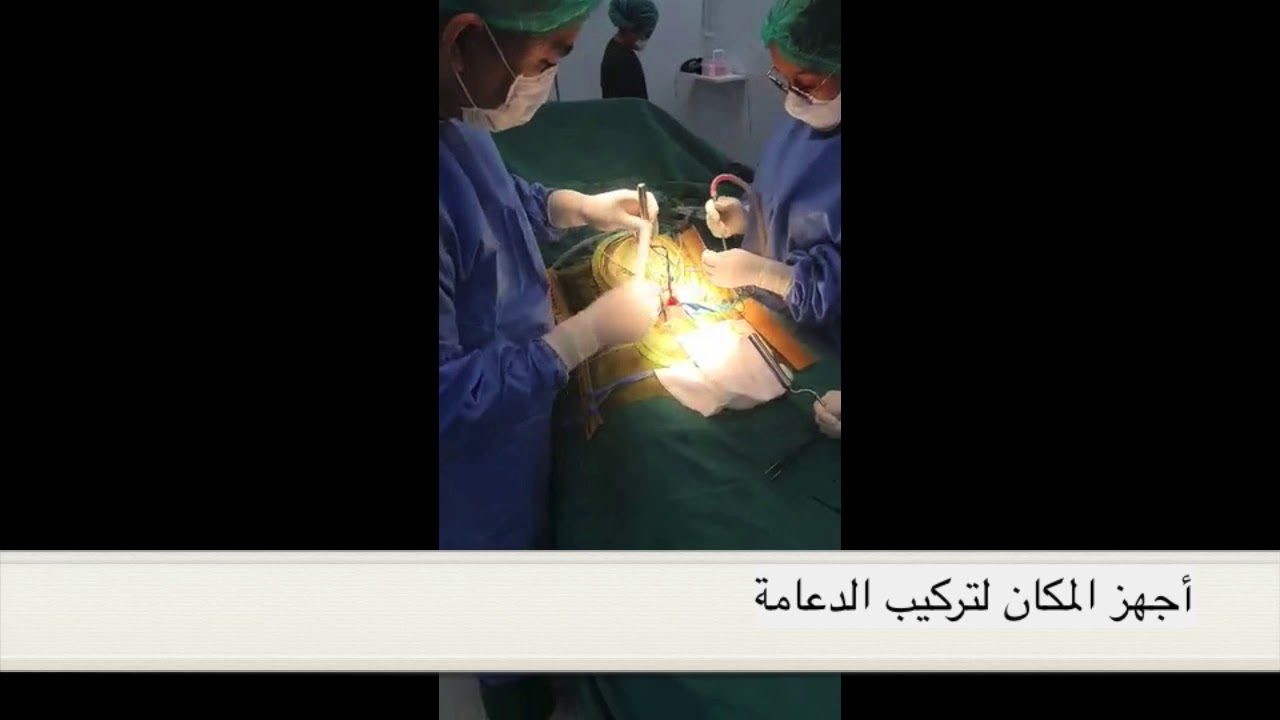 Coloplast Genesis Implantation#7 in Arabic( بالعربية ) Dr.Dechapol Buranapitaksanti