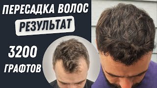 Пересадка Волос в Турции До и После 3200 графтов | Пересадка волос в Турции