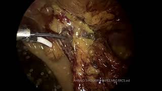 recurrent enterocutaneous fistula. دكتور احمد شكري حافظ.