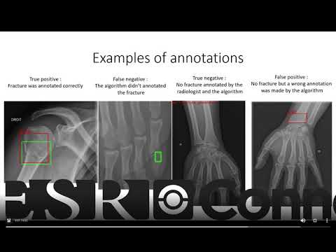 ECR 2020 - G. Reichert : Research Presentation session about fracture detection and deep learning