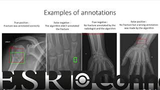 ECR 2020 - G. Reichert : Research Presentation session about fracture detection and deep learning