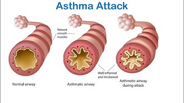 Managing An Asthma Attack