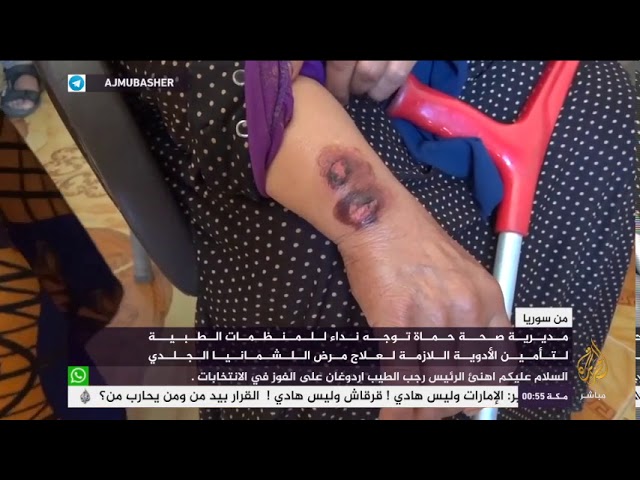 من سوريا.. مديرية صحة حماة توجه نداء للمنظمات الطبية لتأمين علاج مرض اللشمانيا الجلدي