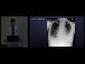Tuberculosis Pulmonar.- Dr. Edgar Hernández