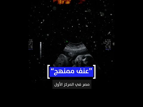عنف ممنهج.. مصر في المركز الأول في الولادة القيصرية