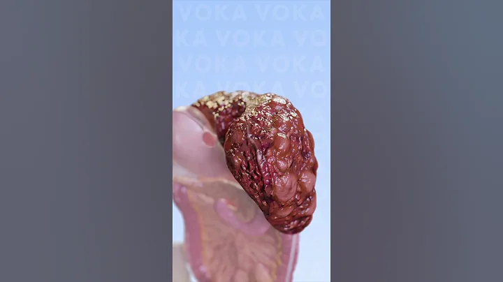 Liver Cirrhosis The Silent Killer You Need to Know About 3D visualization with VOKA Anatomy Pro