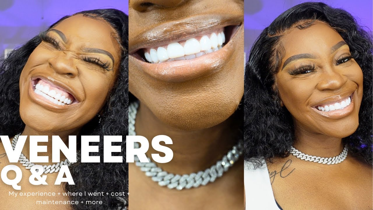 I Got Veneers, Here's What Happened.