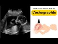 Ref:vKOc3jM7ZB8 Imagerie m�dicale #6 : l �chographie