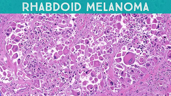 Rhabdoid Melanoma (Metastatic to Lymph Node) patho...