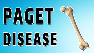 Bones Out of Balance: Understanding Paget's Disease Progression