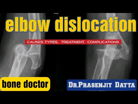 #ELBOW DISLOCATION ,#diagnosis #causes #treatment .Dr.prasenjit datta.bone doctor