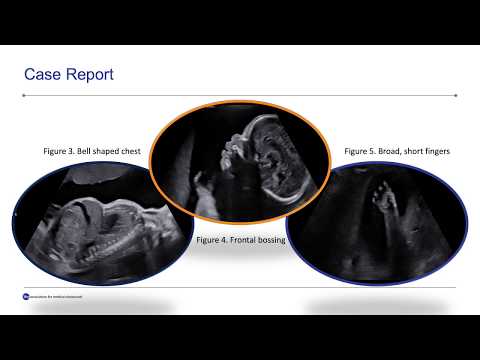 Thanatophoric Skeletal Dysplasia: A Case Report and Review of Literature