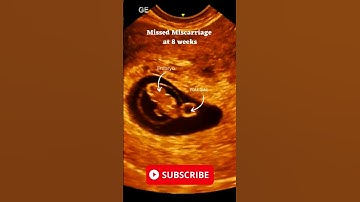 Missed Miscarriage at 8 Weeks Ultrasound  Scan