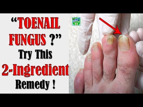 super-easy-2-ingredient-remedy-to-get-rid-of-toenail-fungus-!
