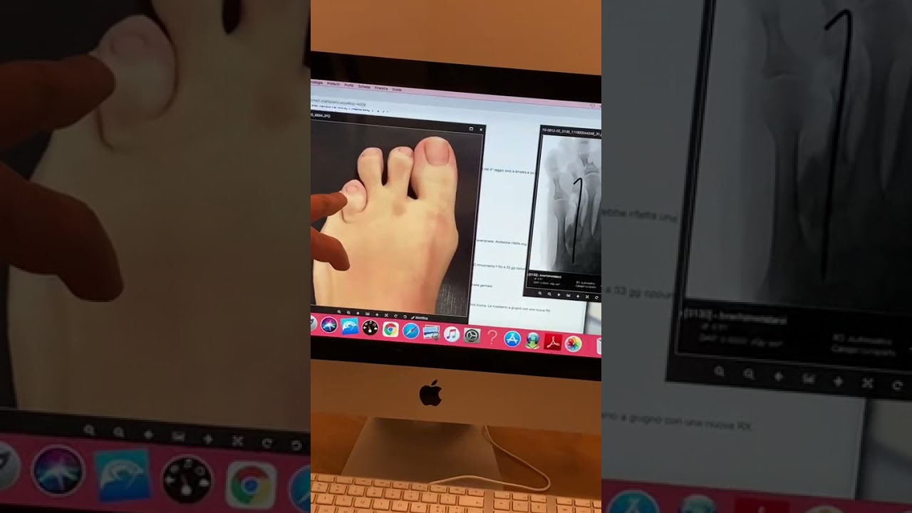 Brachimetatarsia del 4’ raggio. Visita di controllo a 6 mesi