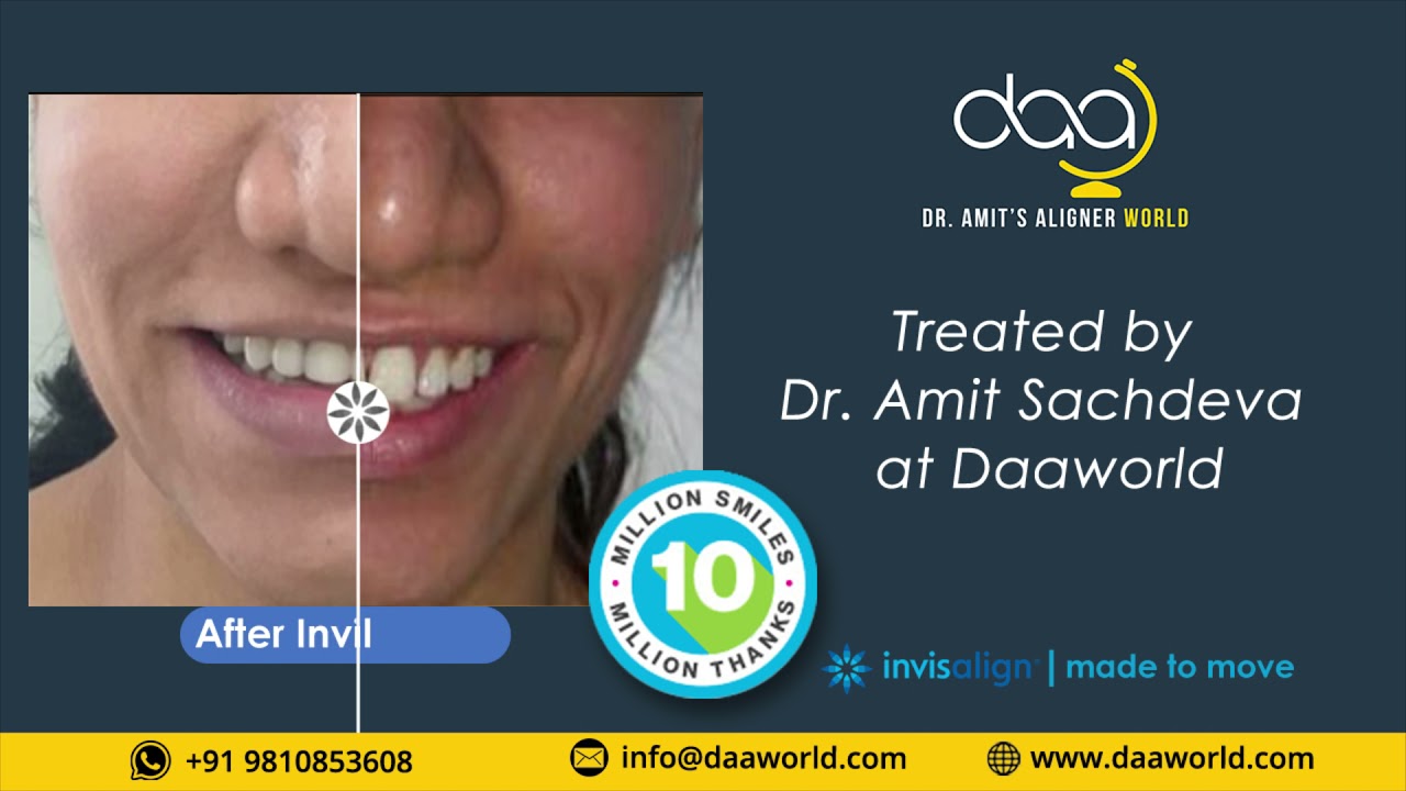 Invisalign Results Treated by Dr Amit Sachdeva at Daaworld. - YouTube