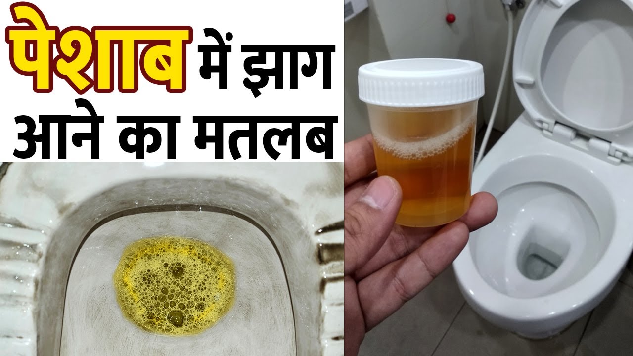 Proteinuria Treatment in Ayurveda पेशाब में प्रोटीन की कमी को रोकने