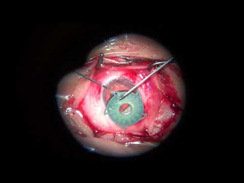 Removal of partial aniridia implants combined with artificial iris implantation