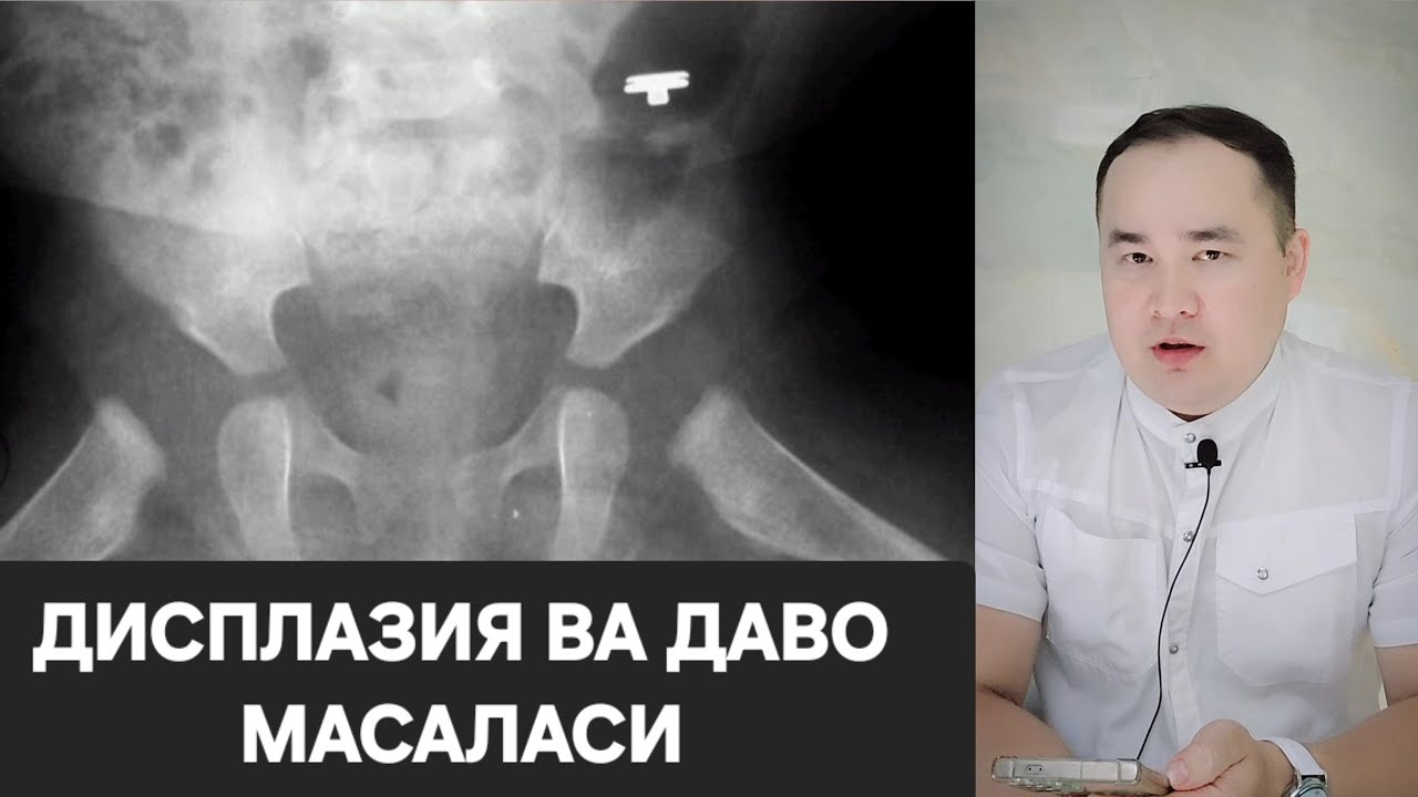 ЧАНОҚ СОН БЎҒИМИ ДИСПЛАЗИЯ МАССАЖ ДАВО БЎЛАДИМИ/ ИСЧАНОВ ЖАВОБ
