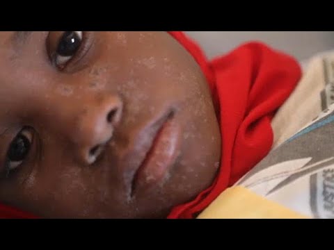 Videó: Kanyaró - Kanyaró Elleni Oltás Felnőtteknek, Különösen Oltás