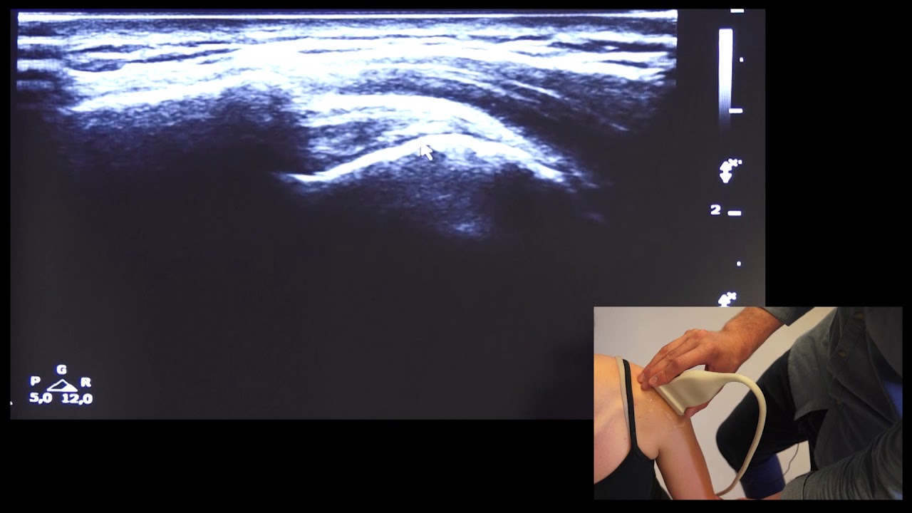 echografie schouder m. supraspinatus tijdens abductie YouTube