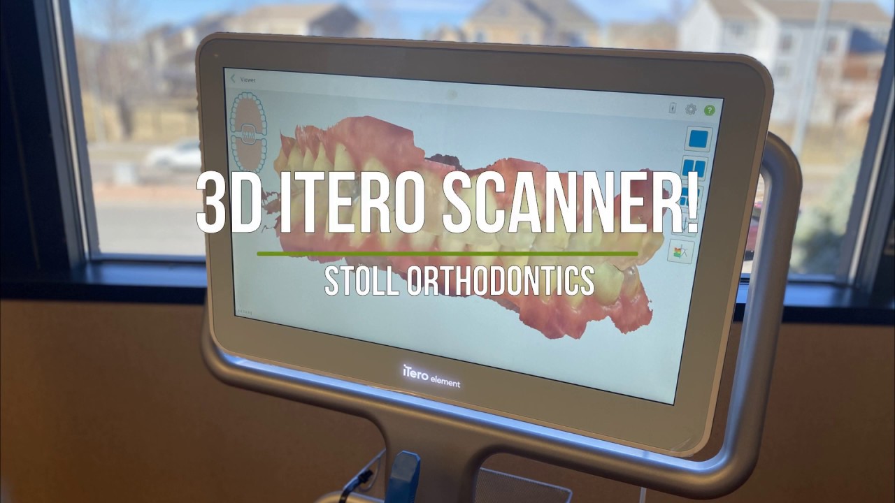3D iTero Scanner! | Smile Simulation | Orthodontist in Thornton, CO