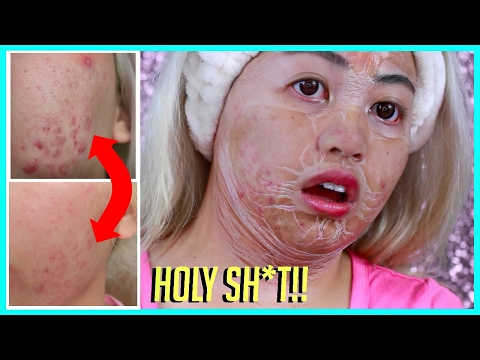 INSANE Face Lifting Pore Tightening ACNE Mask | Hanacure