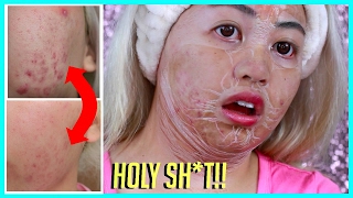 INSANE Face Lifting Pore Tightening ACNE Mask | Hanacure
