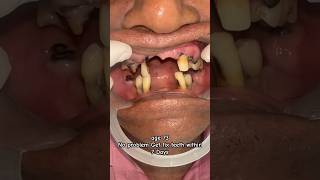 Get Full mouth Implant with fix teeth within 7 Days | #mumbaidental #implants #shorts
