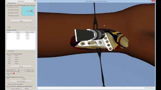 VR Simulator for Distal Radius Fracture Treatment