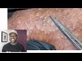 Urban Extraction 😱| ingrown hair removal | Reaction | Freaky Friday Navajo