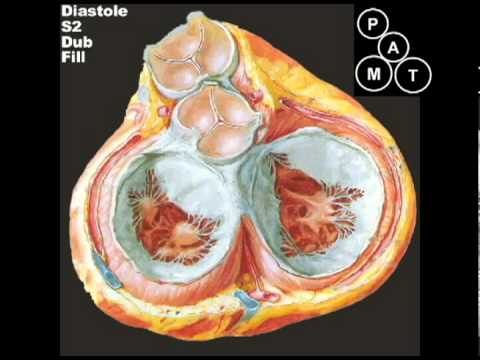 Animated Mitral Regurgitation Murmur