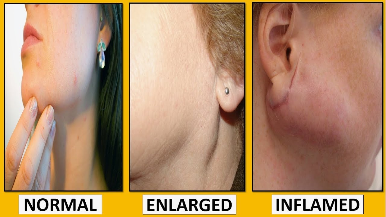 swollen-salivary-gland-stone-infection-pictures-removal-youtube