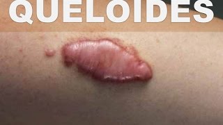 Queloides? ¿El los ayuda hamamelis con