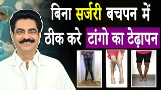Worried about knock knee in your child? Watch This! | Arthritis | Longlivelives Hindi