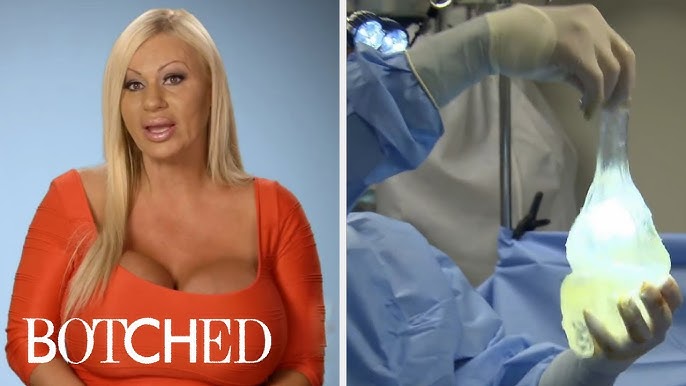 Woman left with a UNIBOOB after botched breast surgery begs