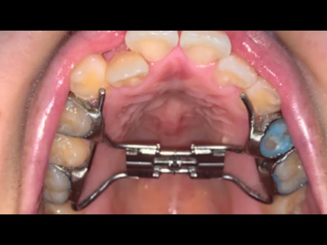 Try wearing the rapid expansion device for 6 months📖 - YouTube