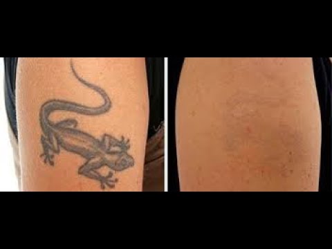 How To Fade A Tattoo - Cheap Tattoo Removal Options - YouTube