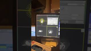 Mrcp  3d mipping.