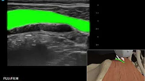 How To: QUADRATUS LUMBORUM BLOCK 3D Video