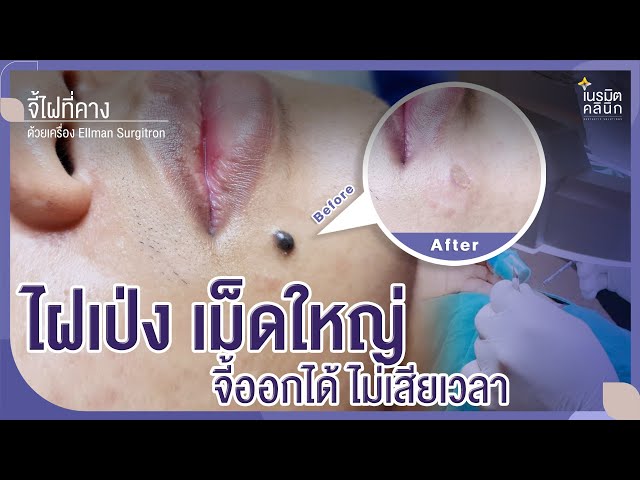 รีวิวตัดไฝ ขี้แมลงวัน EP.161/ไฝเม็ดใหญ่จี้ได้ ใช่เวลาไม่นาน @หมอปุ๊ NeramitClinic