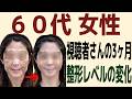 視聴者さんが3ヶ月で若返った、変化した方法！整形級に激変した魔法のケア※ほうれい線・ブルドッグ顔